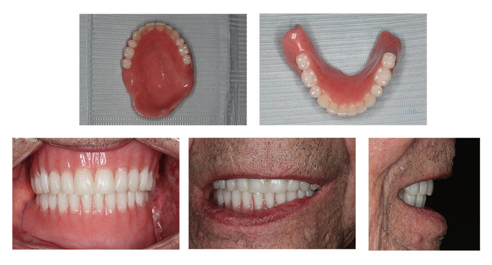 cancer-obturator-2-after