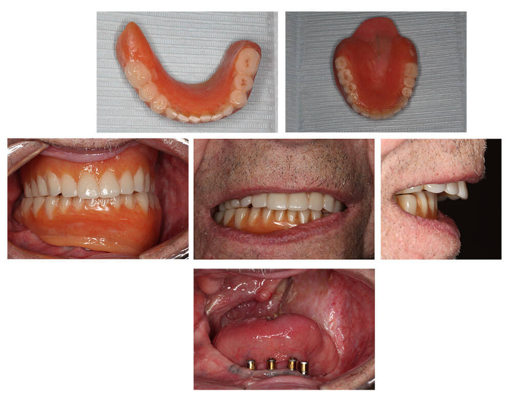 cancer-obturator-2-before